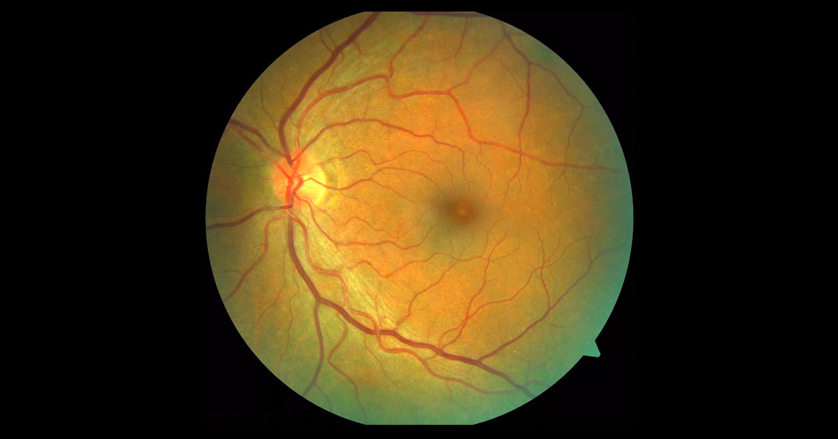 Colour fundus photograph of the left eye demonstrates a yellow spot at the fovea.